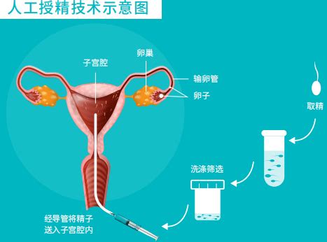 人工授精和试管婴儿有什么区别 哪个成功率高费用低 - 好孕无忧